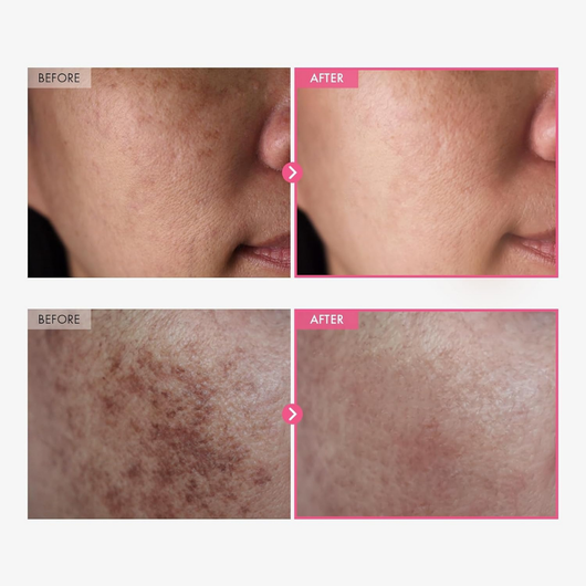 Arbutin 7% & Tranexamic Acid 4% Brightening Cream VIP