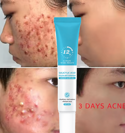 BOBO Effective repair acne scar anti-spot removal gel